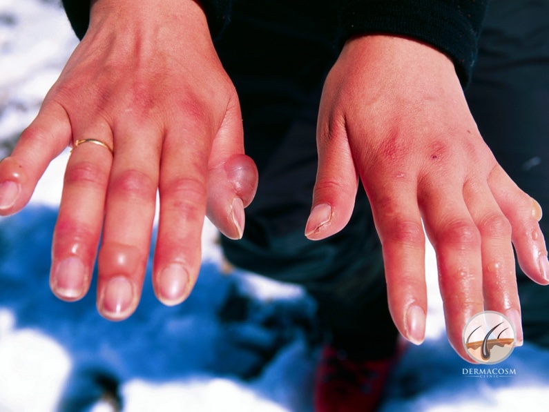 chilblains