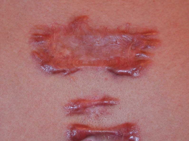 keloid